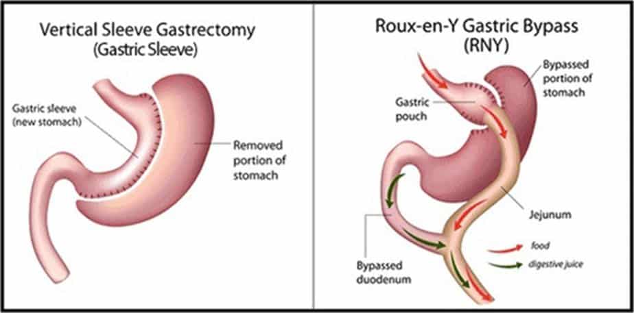 Gastric Sleeve Vs. Gastric Bypass Surgery