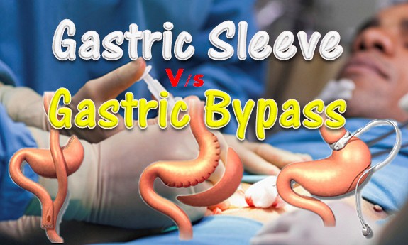 Gastric Sleeve and Gastric Bypass Surgery Compared