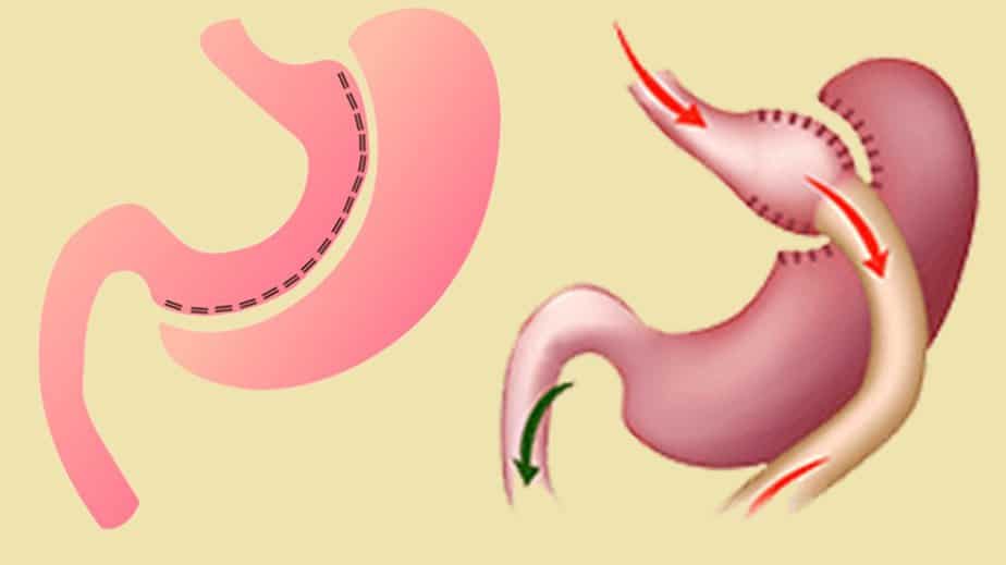 Sleeve gastrectomy and gastric bypass
