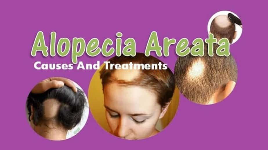 Alopecia Areata