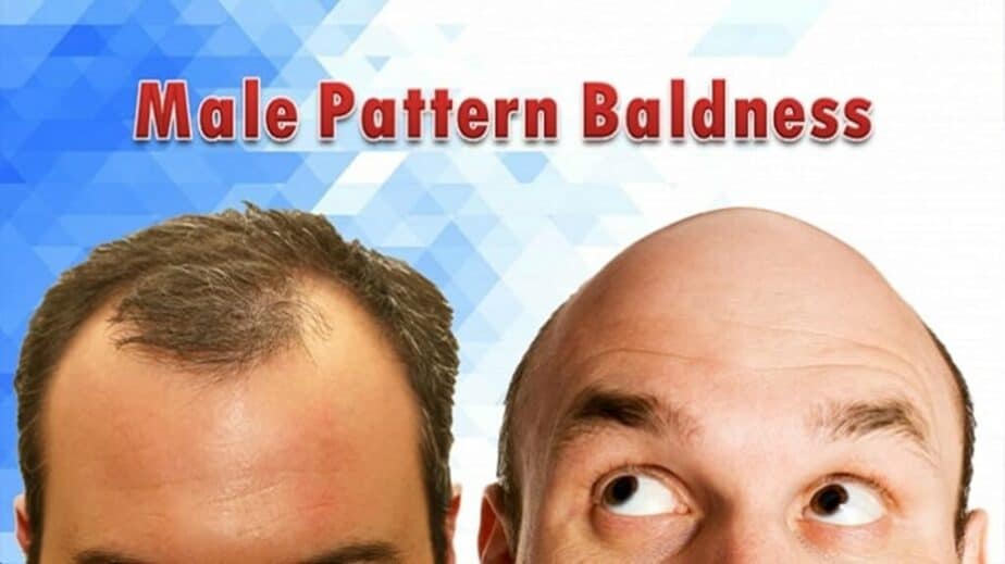 Male Pattern Baldness