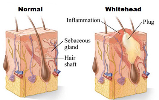 Causes Of White Heads 