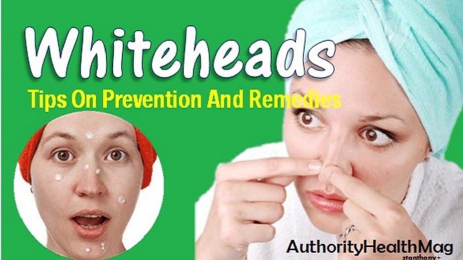 How To Get Rid Of Whiteheads