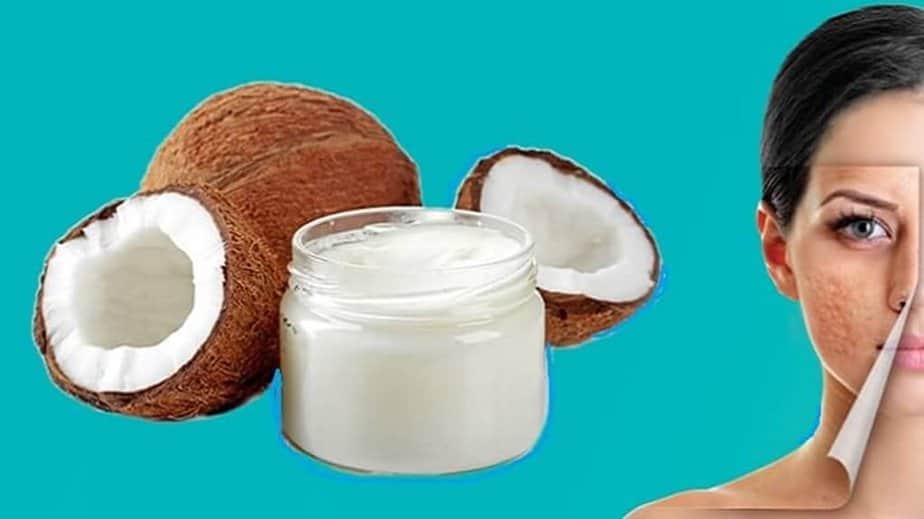 Coconut Oil for Acne Scar