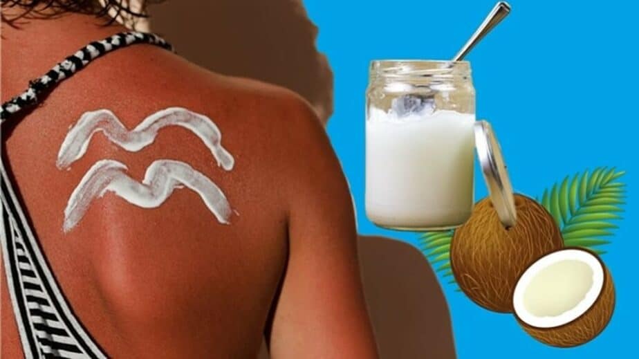 Coconut Oil for Sunburn
