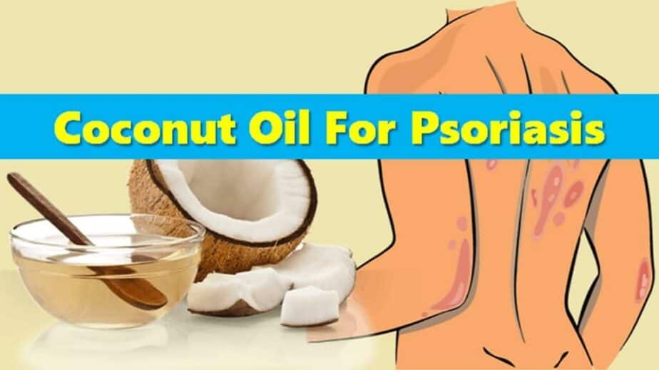 Coconut Oil For Psoriasis