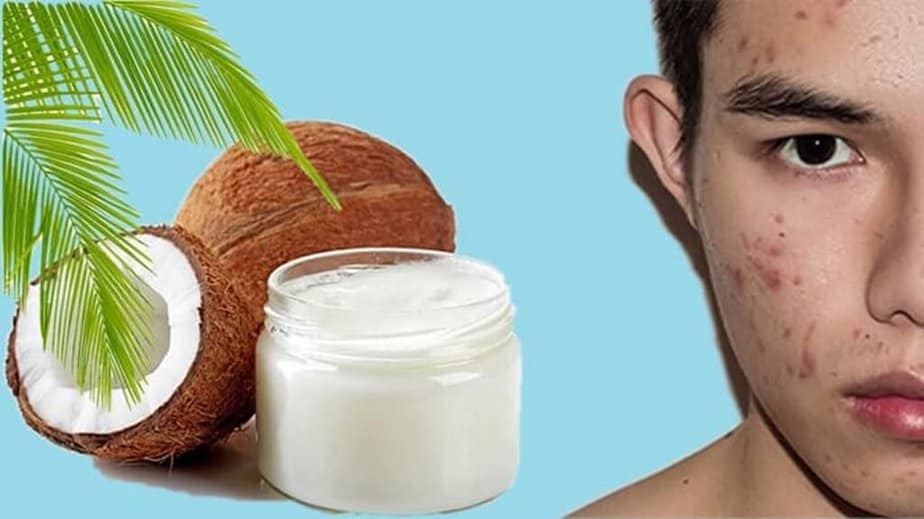 Coconut Oil For Acne Benefits And Usage
