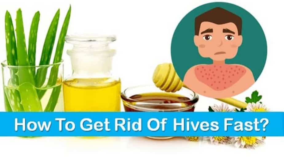 How To Get Rid Of Hives