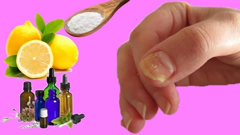Yellow Finger Nails And Toenails Treatment 