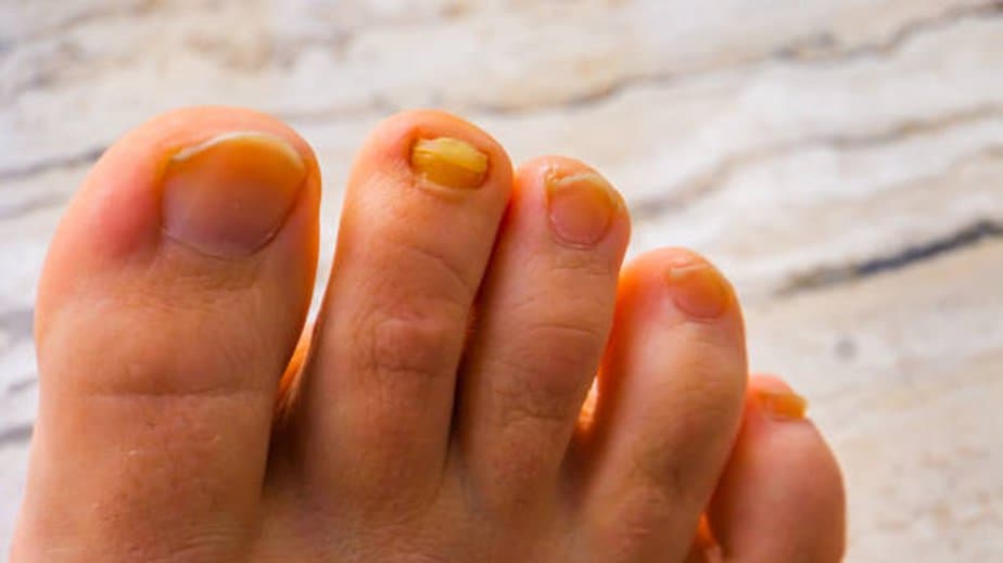 Yellow Toenails