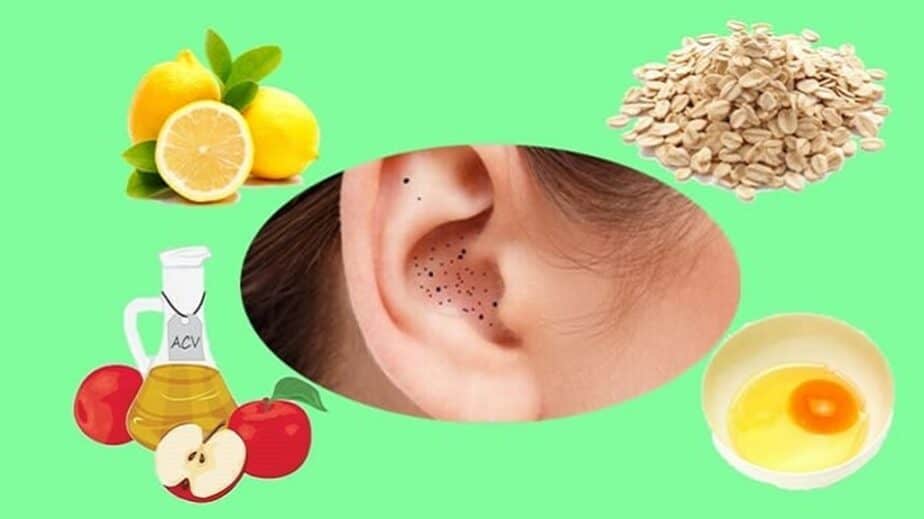 How To Get Rid Of Blackheads