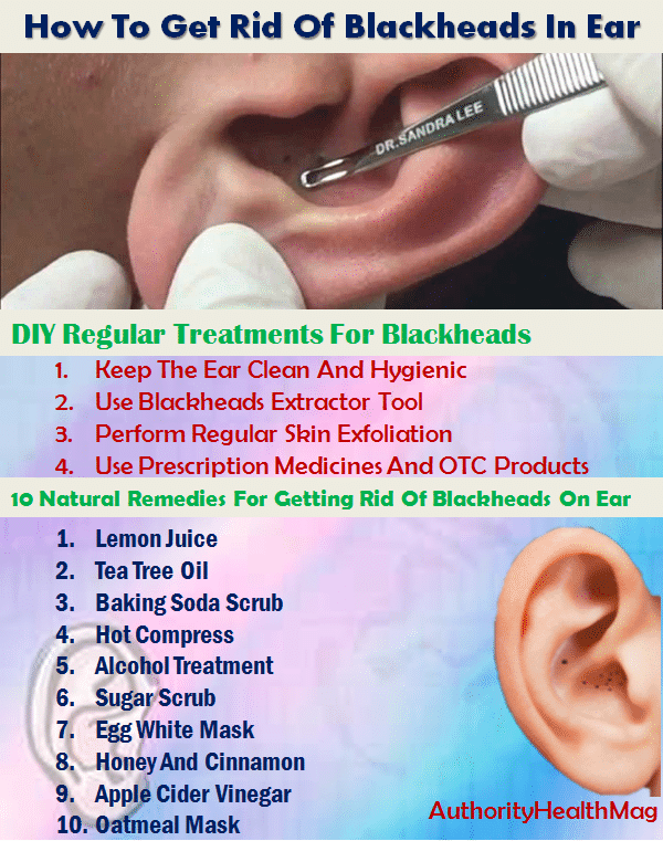 how to get rid of blackheads with home remedies