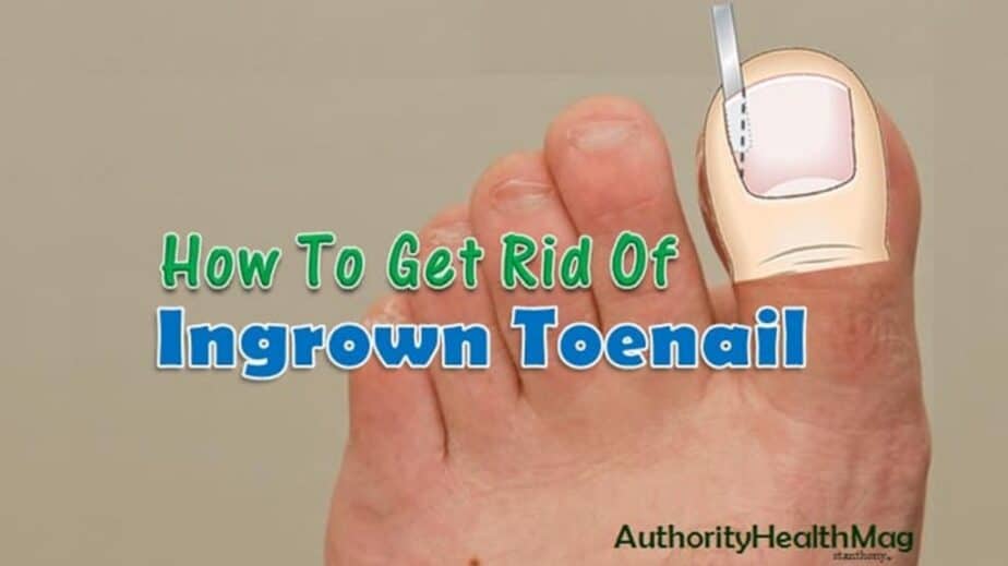 How To Get Rid Of Ingrown Toenail