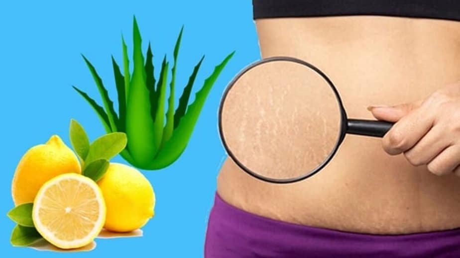 How To Get Rid Of Stretch Marks