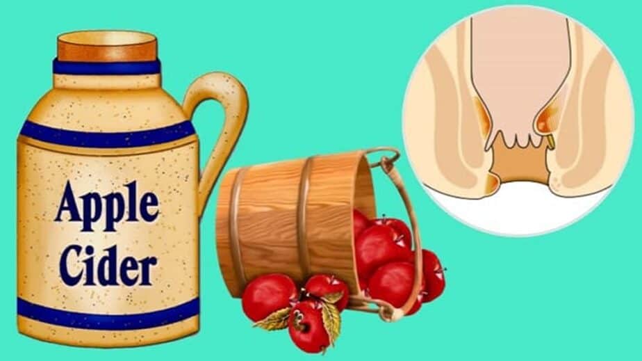 Apple Cider Vinegar For Hemorrhoids