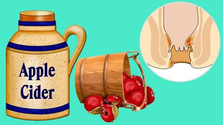 Apple Cider Vinegar For Hemorrhoids
