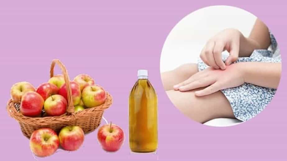Apple Cider Vinegar For Eczema