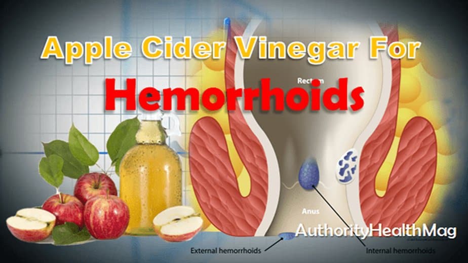 Benefits Of Using Apple Cider Vinegar For Hemorrhoids 