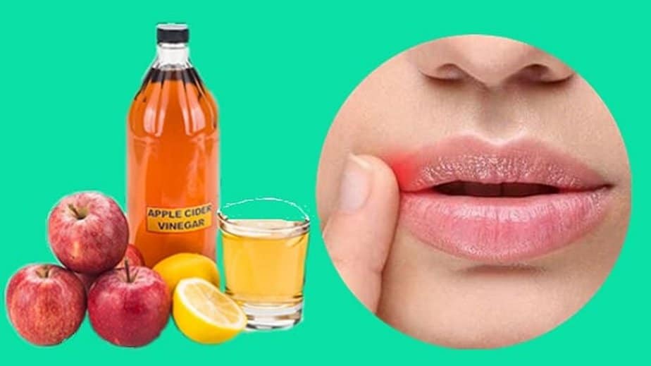 Apple Cider Vinegar For Cold Sores