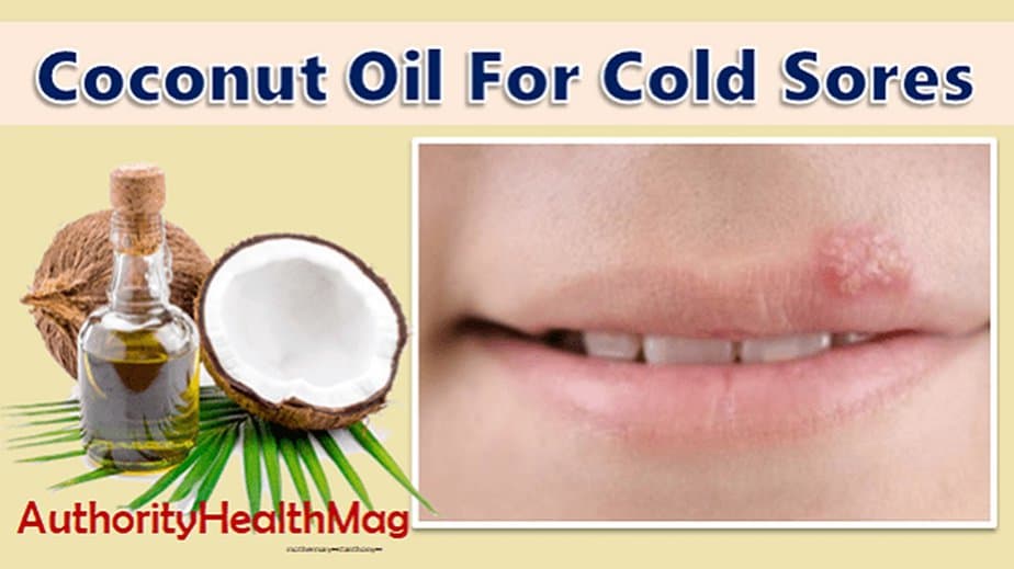 Coconut Oil For Cold Sores