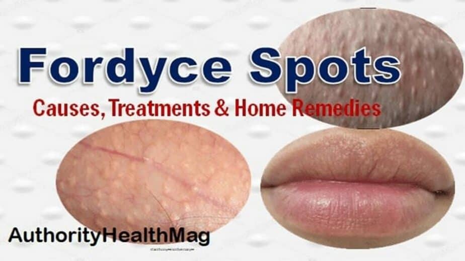 How To Get Rid Of Fordyce Spots