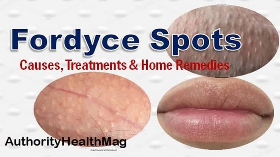 How Do I Get Rid Of Fordyce Spots On My Genital Area At Savannah 