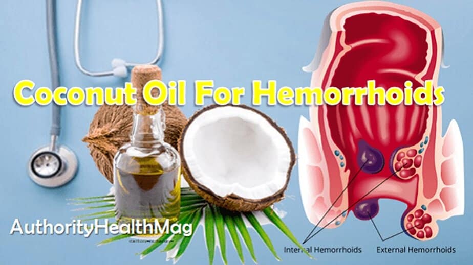 how to use coconut oil for homorrhoids treatment