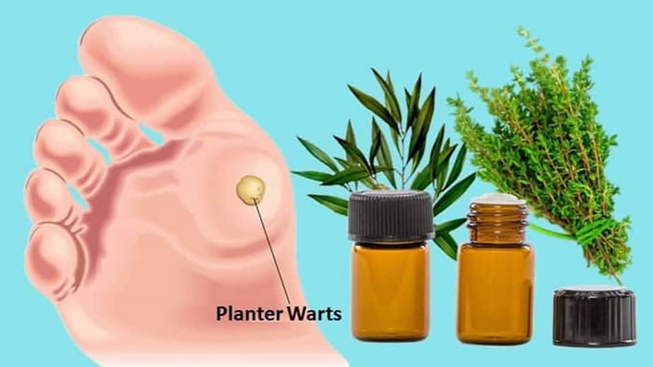 Essential Oils For Warts