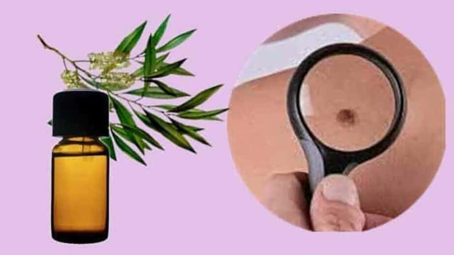 Tea Tree Oil For Skin Tags Removal