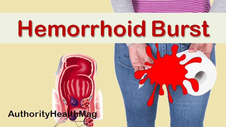 Can Hemorrhoids Burst
