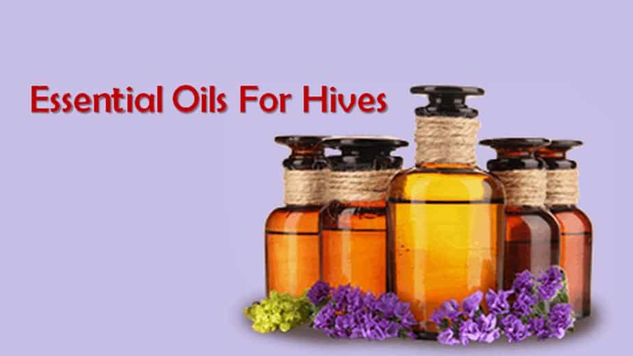 How Do Essential Oils For Hives Help 
