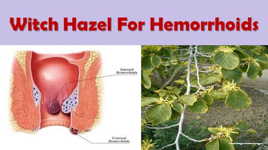 How To Use Witch Hazel For Hemorrhoids 