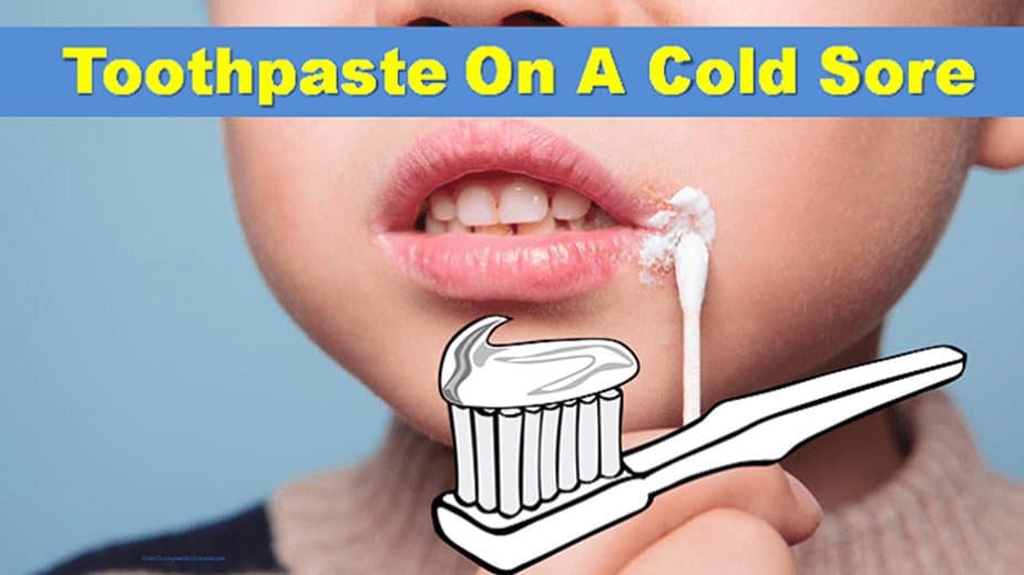 Does Using Toothpaste On A Cold Sore Work