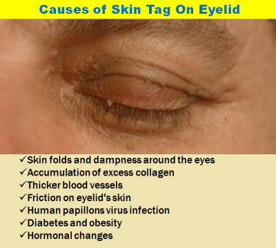 do skin tags on eyelids go away do skin tags on eyelids go away