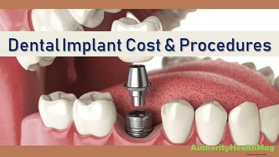 Dental Implants Cost
