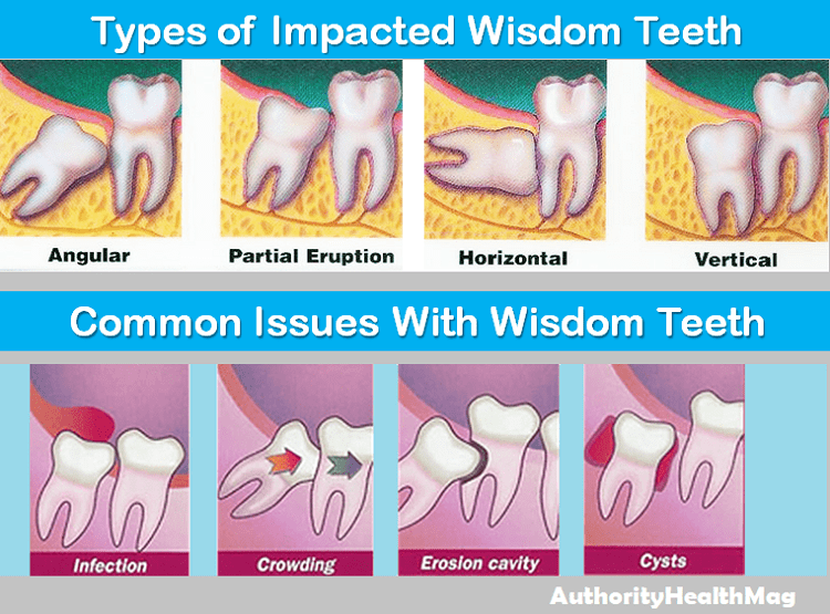 Impacted Wisdom Tooth