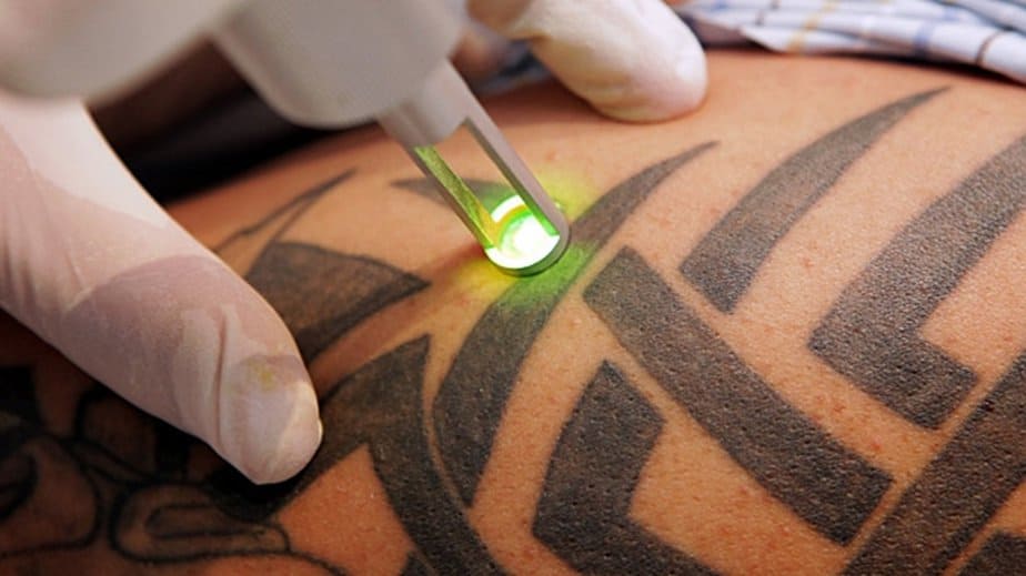 tattoo removal