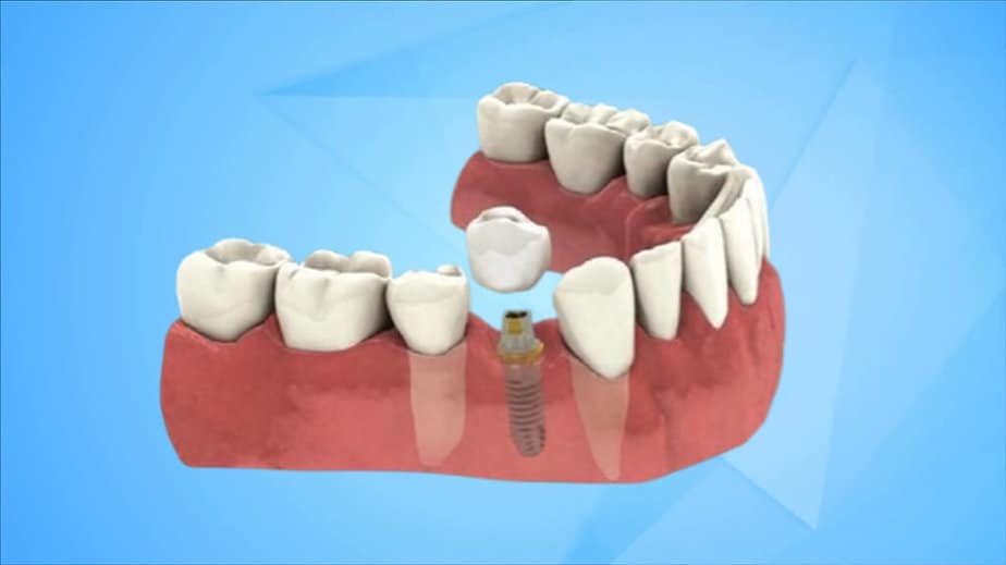 Dental Implant For Seniors